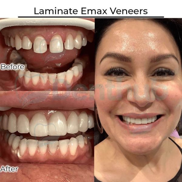 Dental Veneers