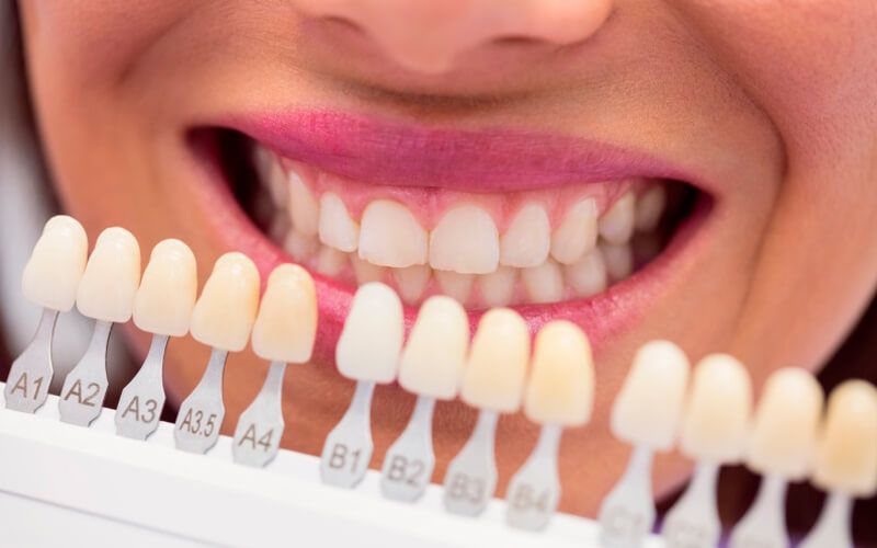 Dental Veneers