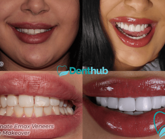 smile makeover
