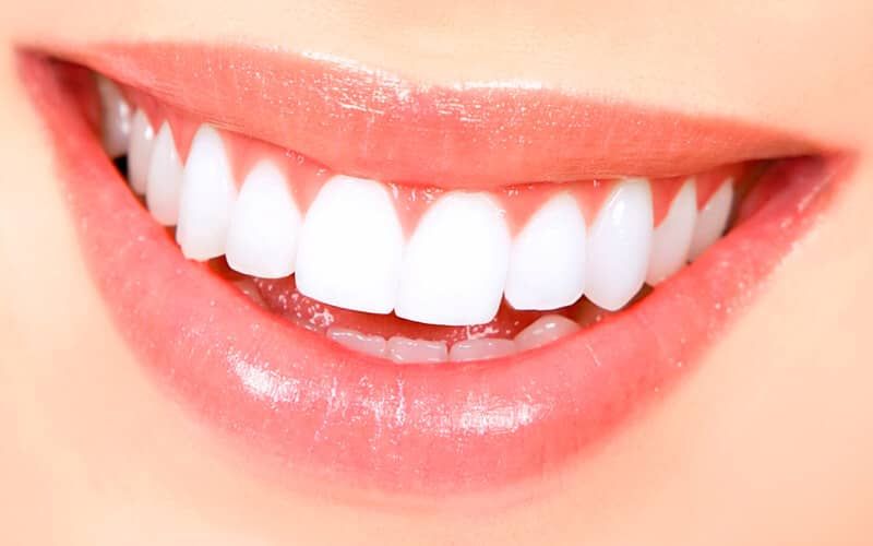 Perfect Smile