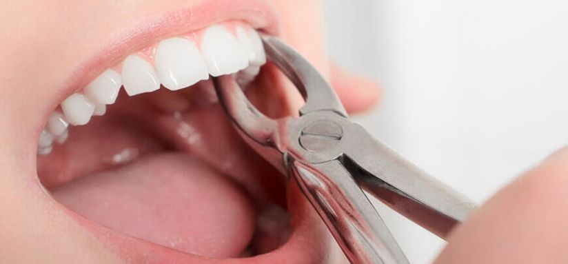 Tooth Extraction